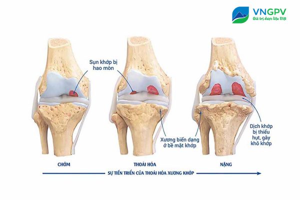 điều trị thoái hóa khớp gối